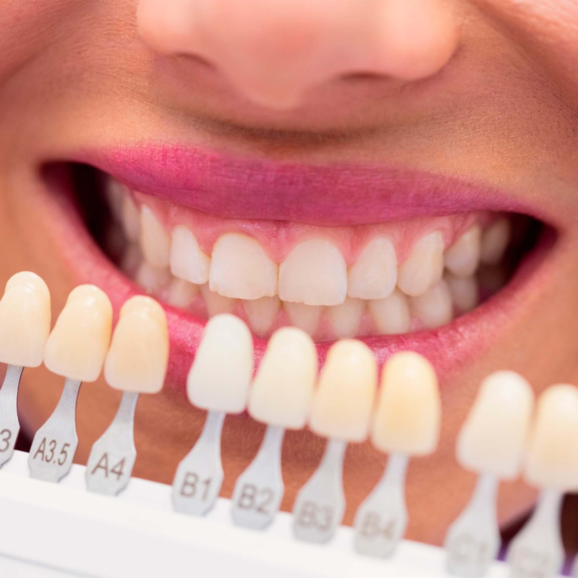 ¿De qué están hechas las prótesis dentales?