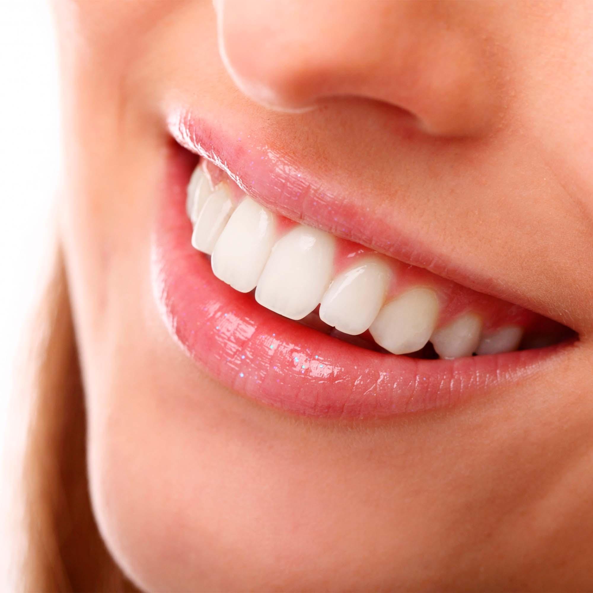 ¿Qué son las carillas dentales y el blanqueamiento dental?